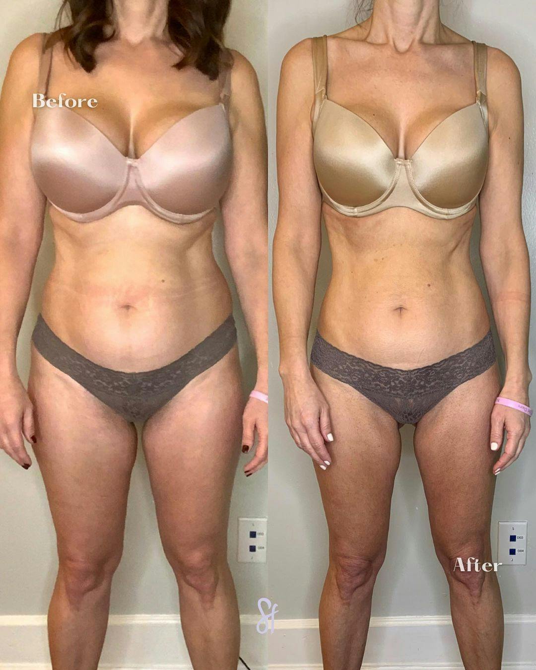 GLP-1 - Weight Loss Before & After Gallery - Patient 157580380 - Image 2