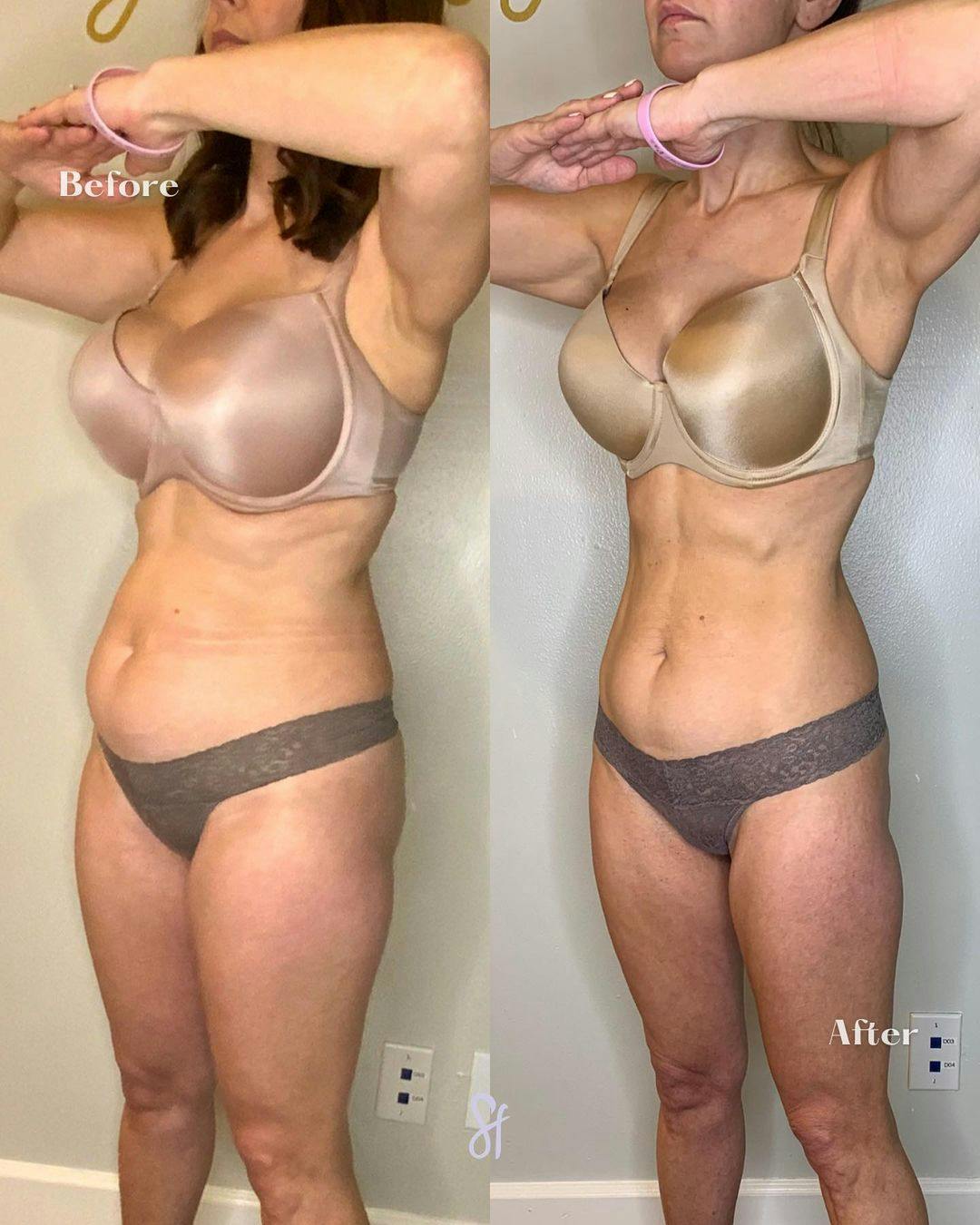 GLP-1 - Weight Loss Before & After Gallery - Patient 157580380 - Image 3