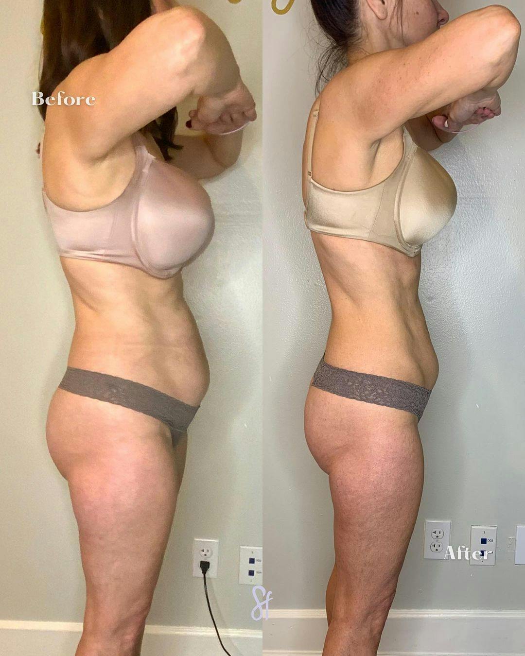 GLP-1 - Weight Loss Before & After Gallery - Patient 157580380 - Image 5