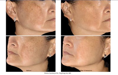 RF Microneedling Before & After Gallery - Patient 120568 - Image 1