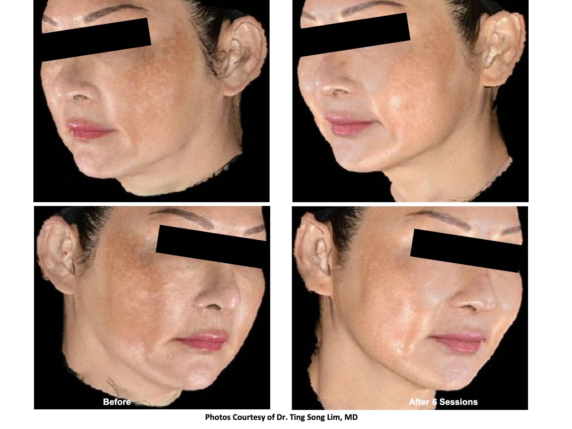 RF Microneedling Before & After Gallery - Patient 346606 - Image 1