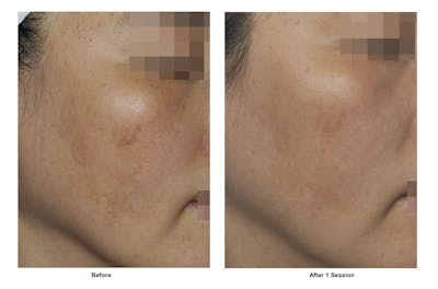 RF Microneedling Before & After Gallery - Patient 108080 - Image 1