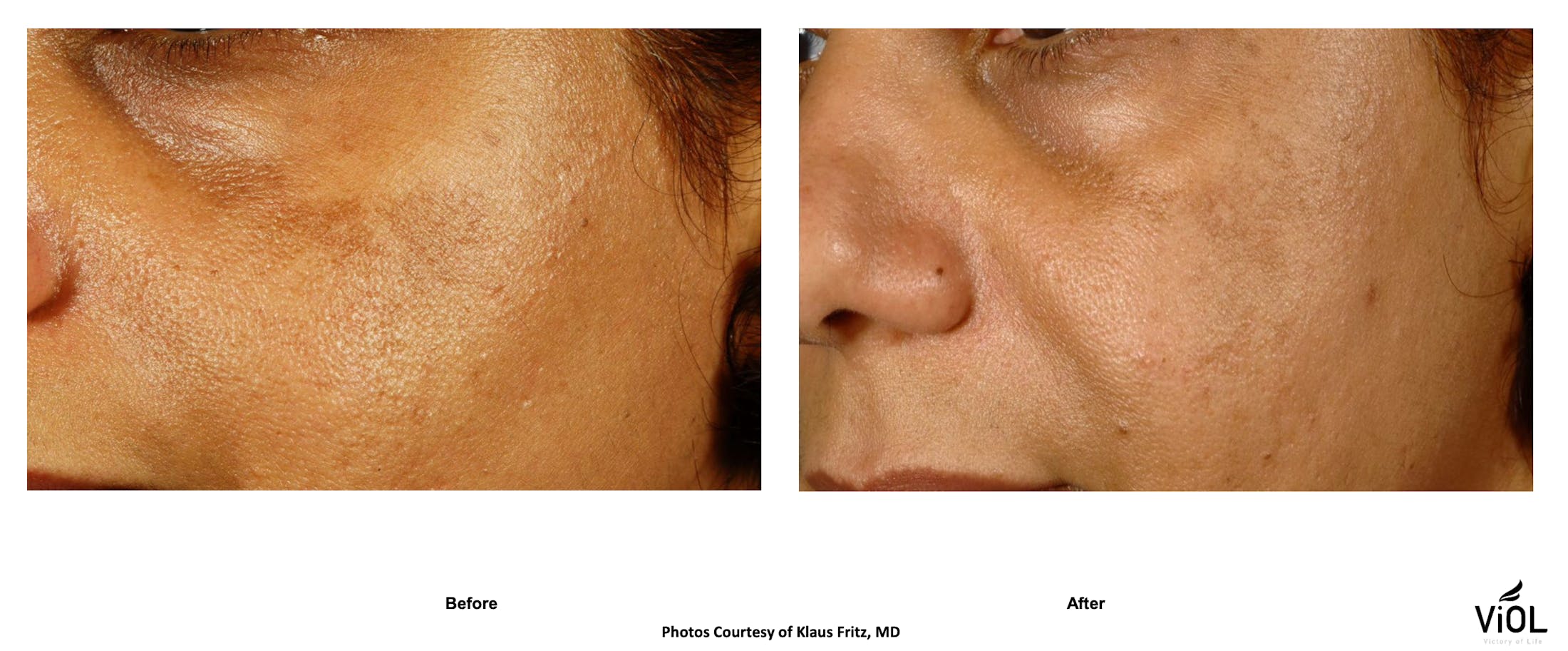 RF Microneedling Before & After Gallery - Patient 401694 - Image 1