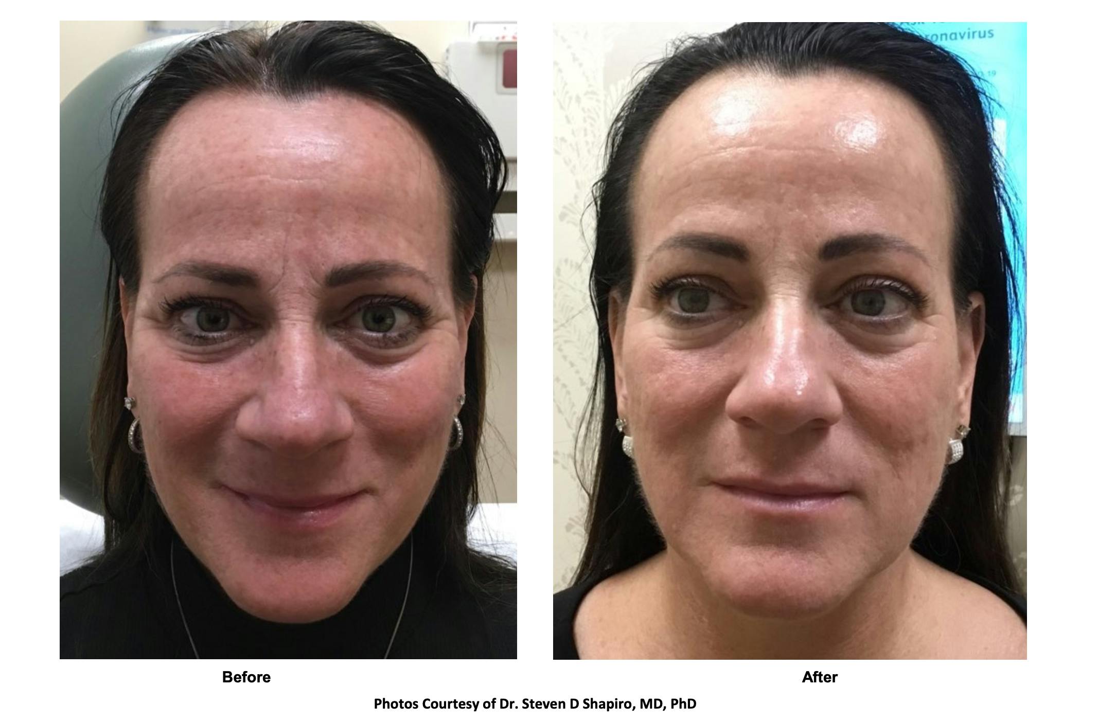 RF Microneedling Before & After Gallery - Patient 211001 - Image 1