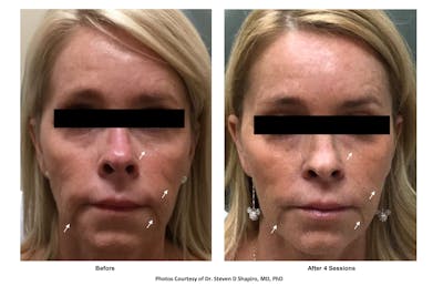 RF Microneedling Before & After Gallery - Patient 152610 - Image 1