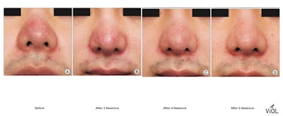 RF Microneedling Before & After Gallery - Patient 118021 - Image 1