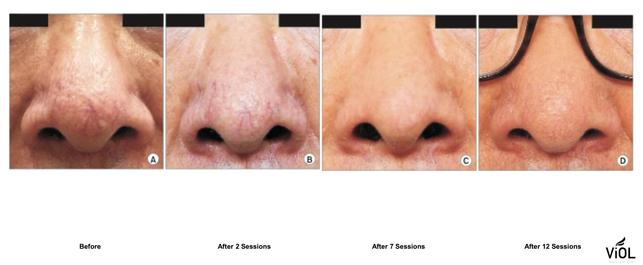 RF Microneedling Before & After Gallery - Patient 364496 - Image 1