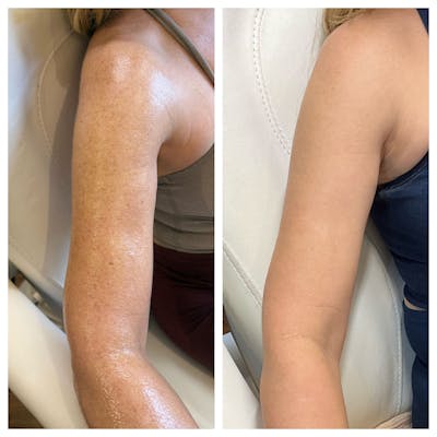 IPL Before & After Gallery - Patient 363119 - Image 1