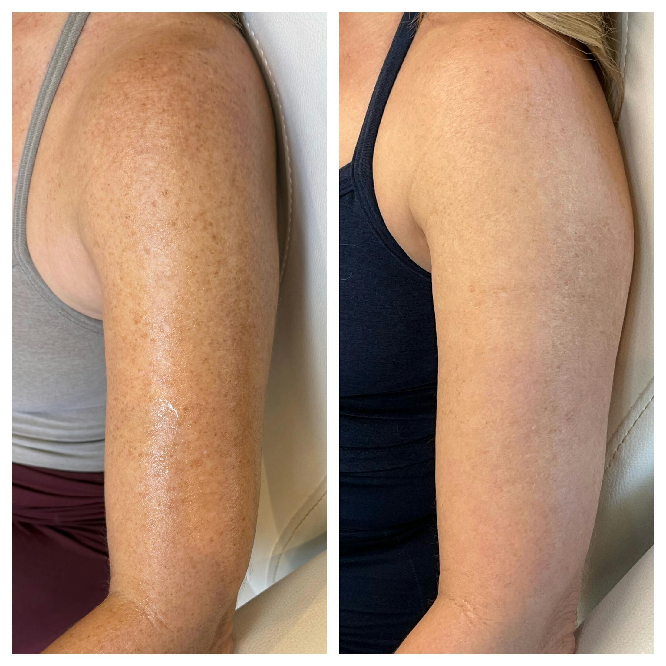 IPL Before & After Gallery - Patient 363119 - Image 2