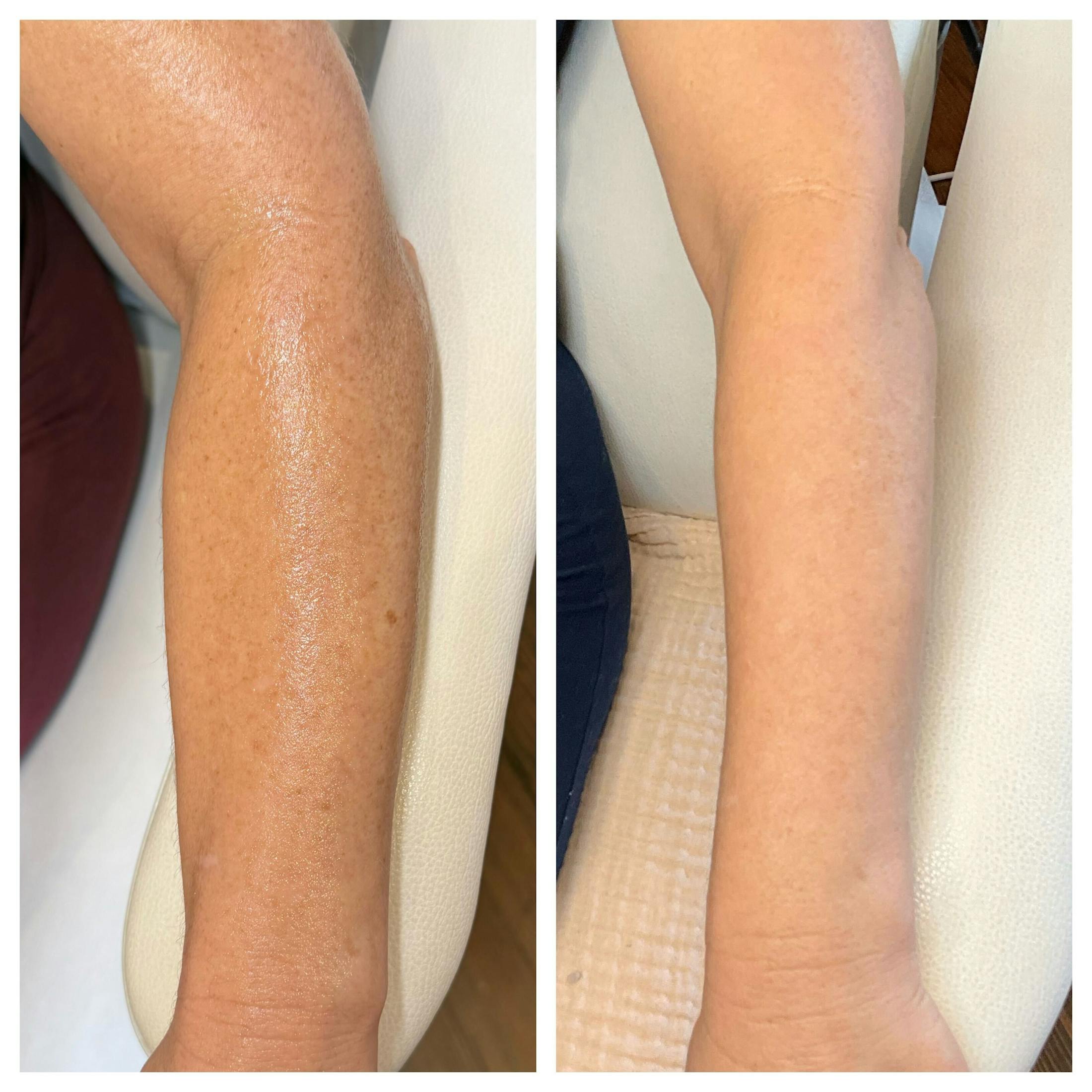 IPL Before & After Gallery - Patient 363119 - Image 3