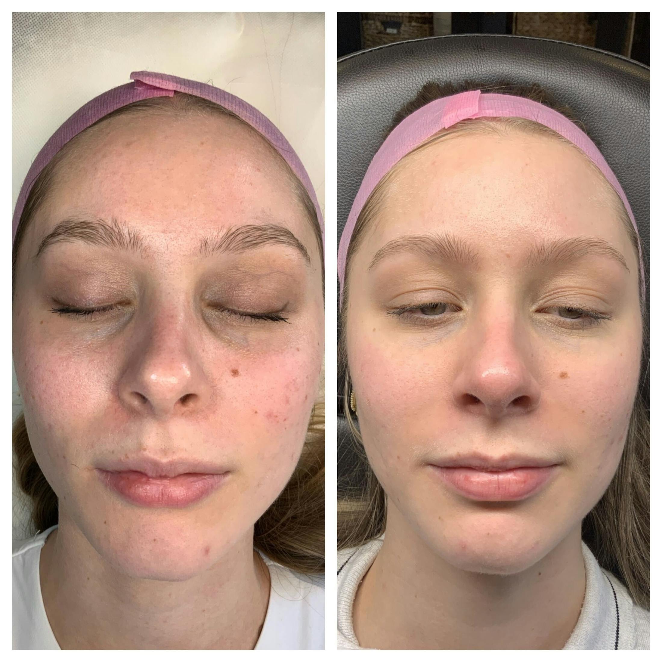 RF Microneedling Before & After Gallery - Patient 108043 - Image 1