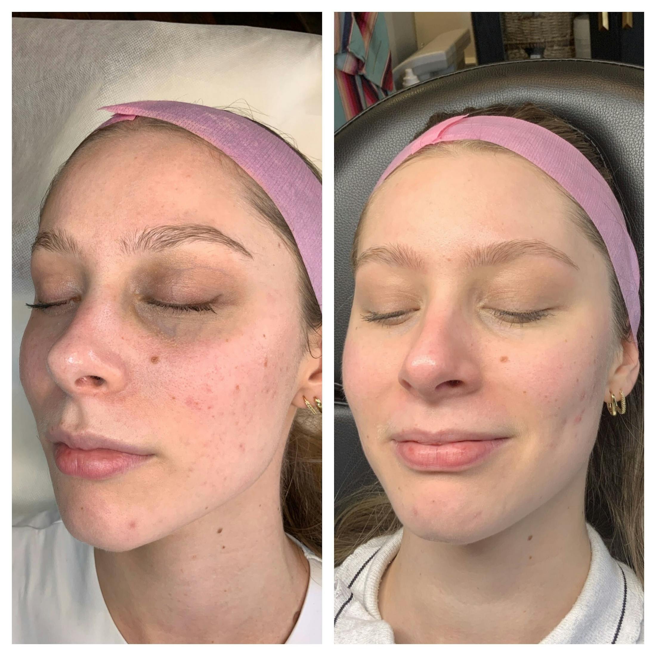 RF Microneedling Before & After Gallery - Patient 108043 - Image 2