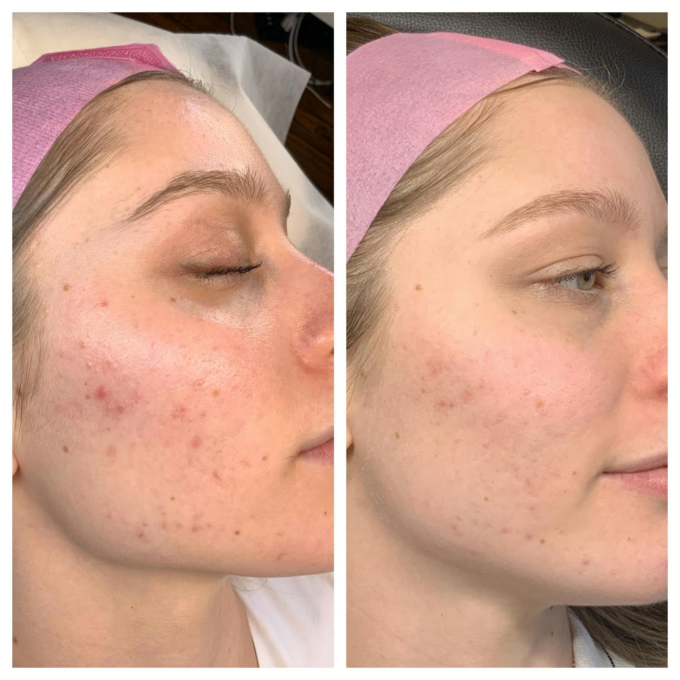 RF Microneedling Before & After Gallery - Patient 108043 - Image 4