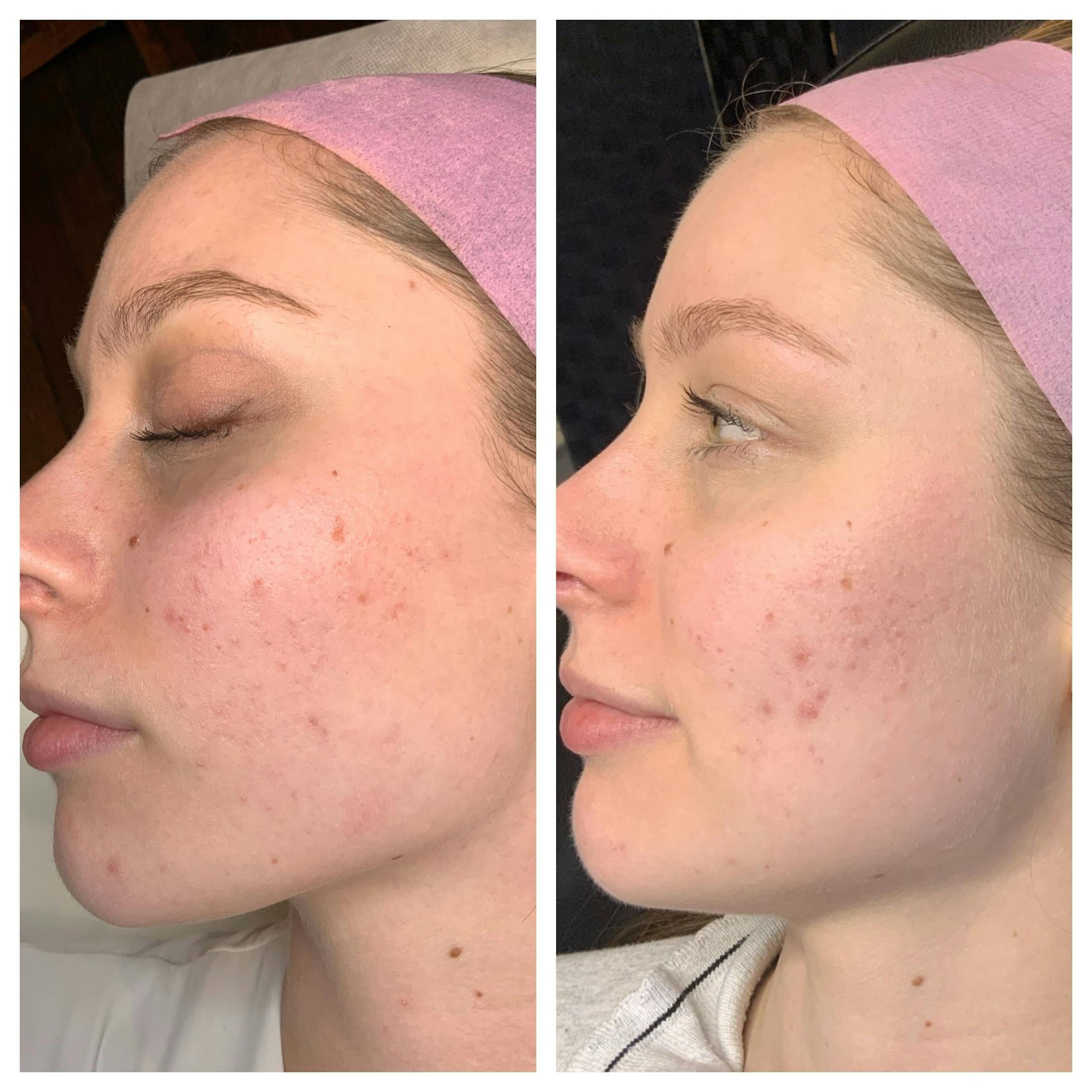RF Microneedling Before & After Gallery - Patient 108043 - Image 3