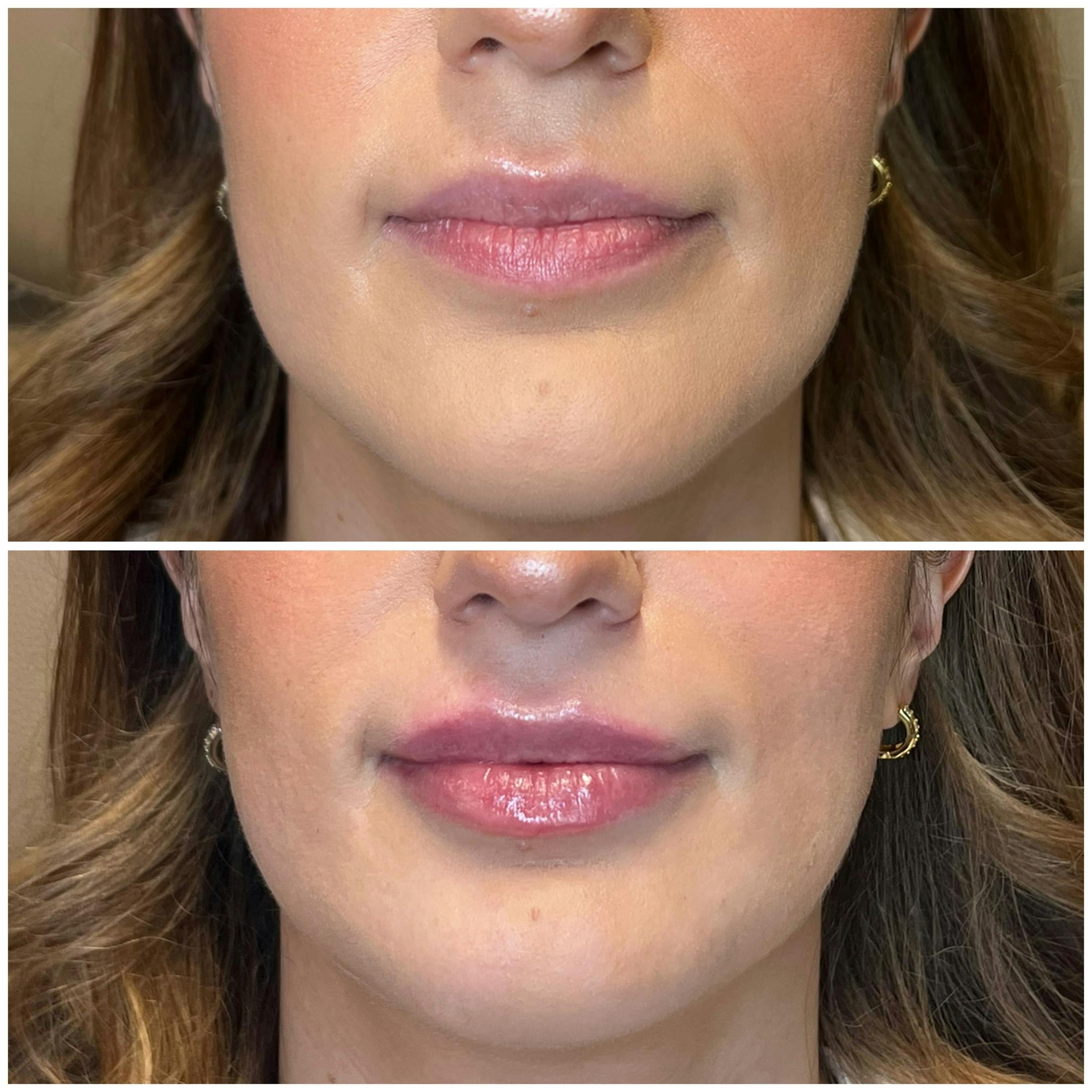 Lips Before & After Gallery - Patient 400334 - Image 1