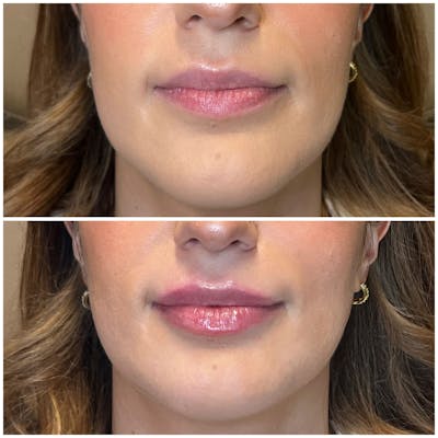 Lips Before & After Gallery - Patient 400334 - Image 1