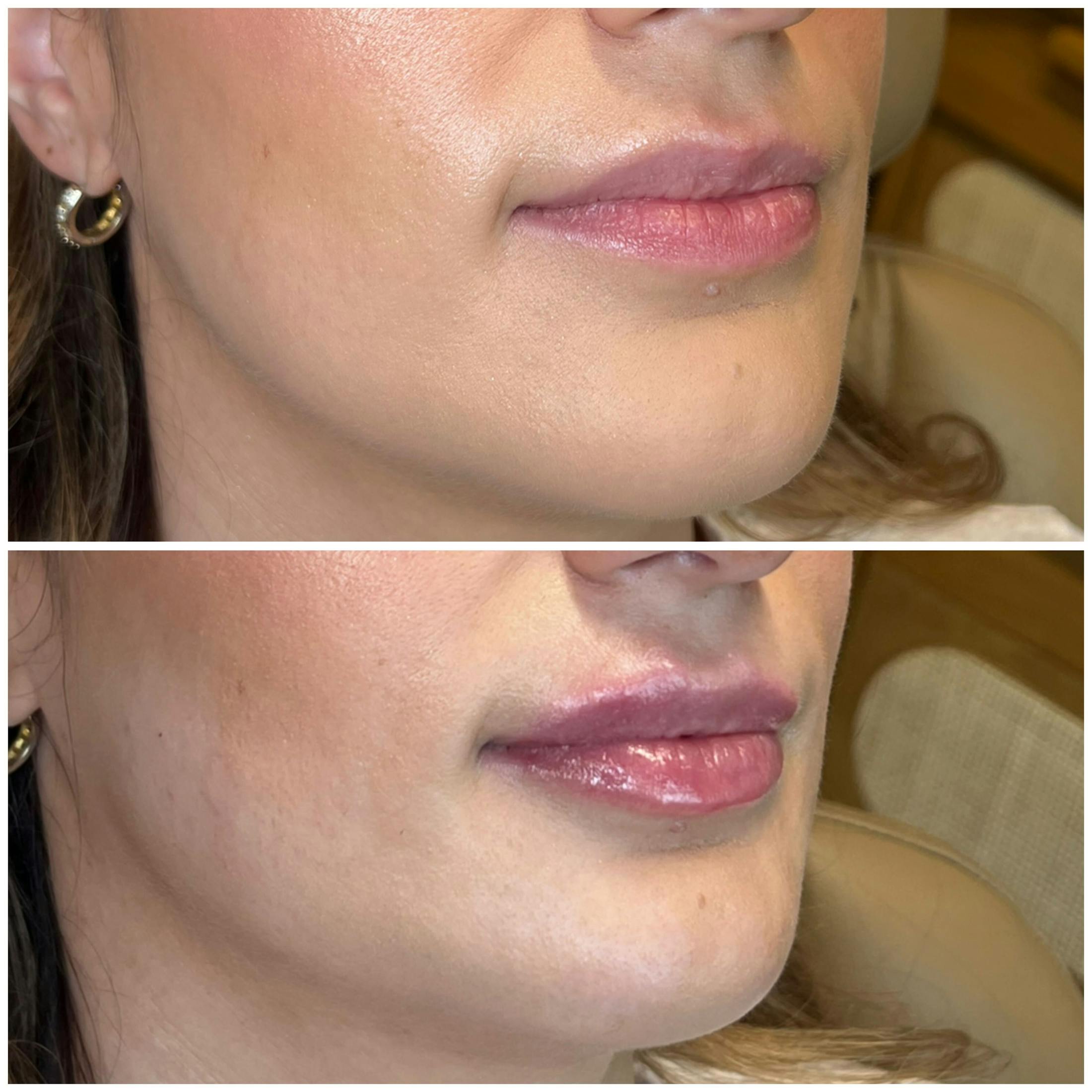 Lips Before & After Gallery - Patient 400334 - Image 2