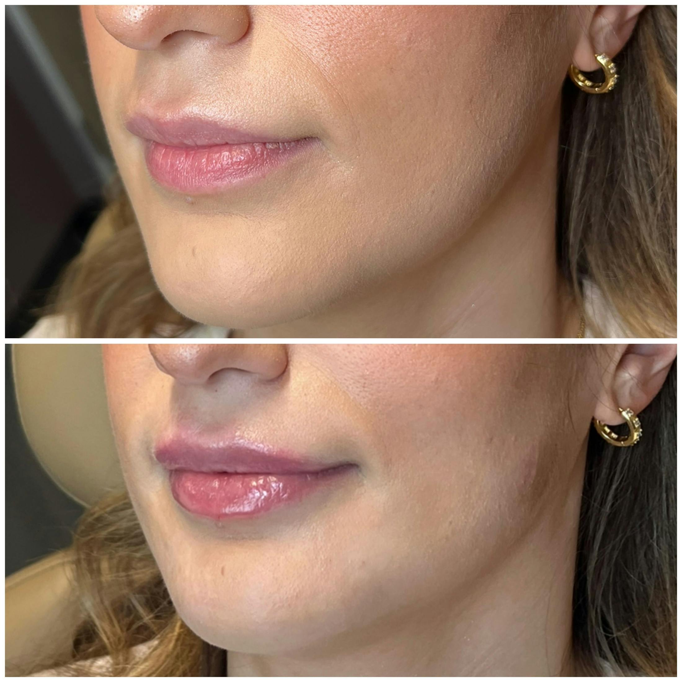 Lips Before & After Gallery - Patient 400334 - Image 3