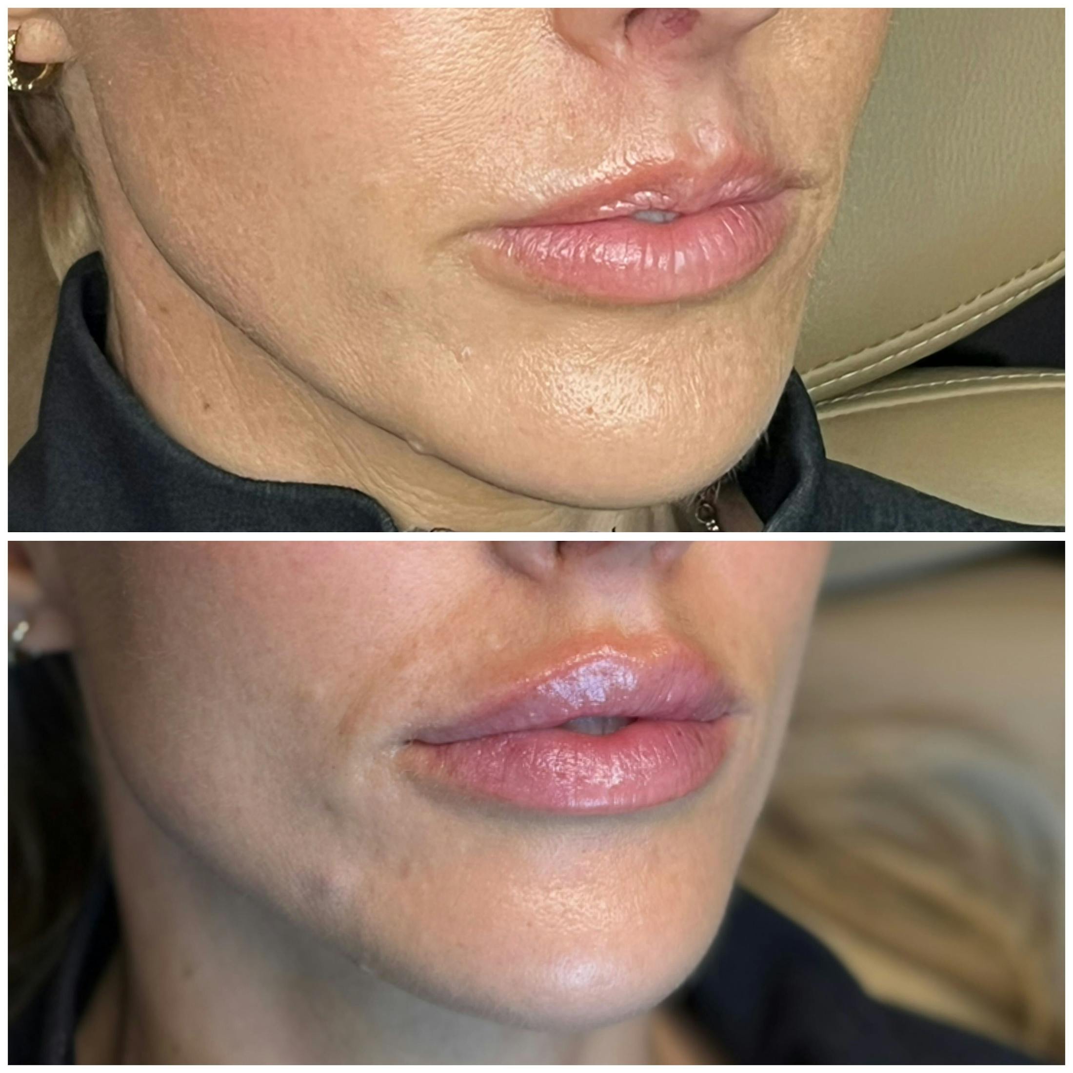 Lips Before & After Gallery - Patient 172037 - Image 1