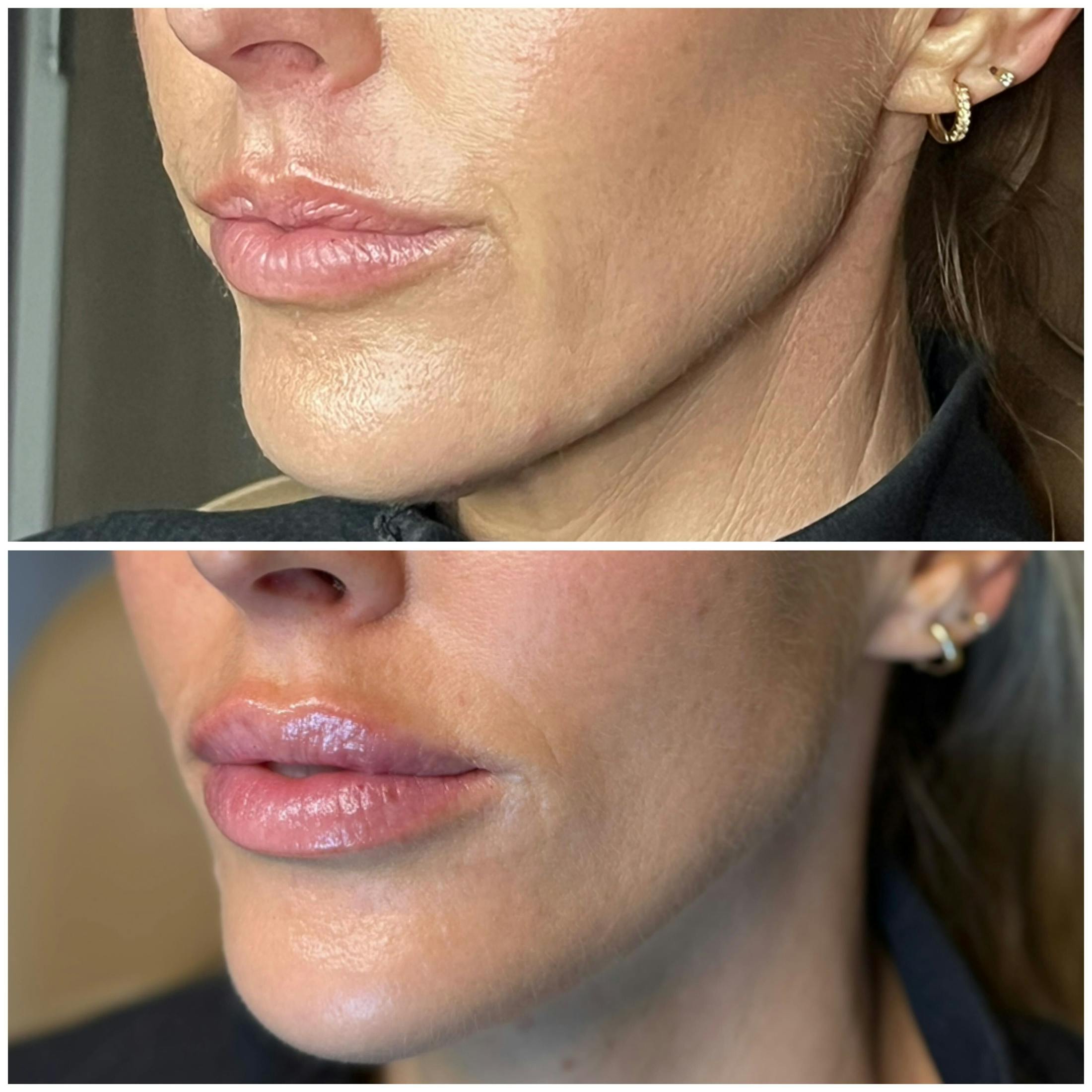 Lips Before & After Gallery - Patient 172037 - Image 2