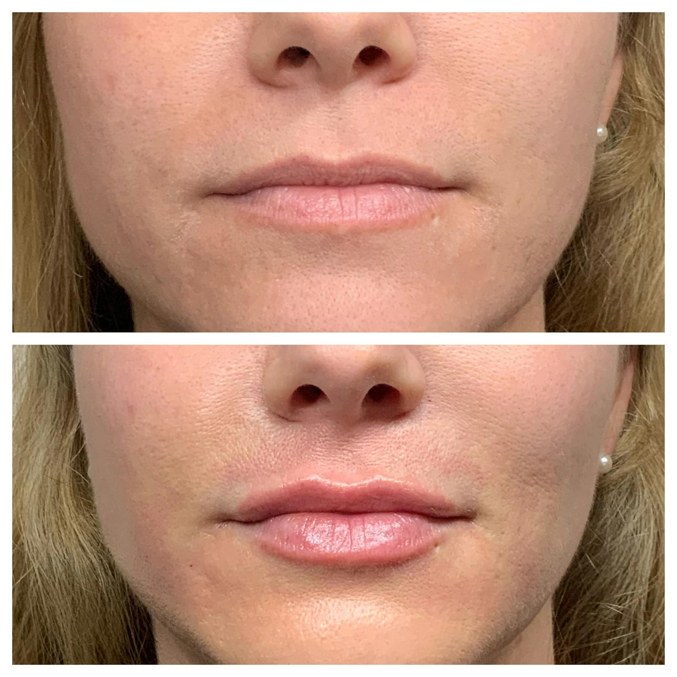 Lips Before & After Gallery - Patient 363148 - Image 1