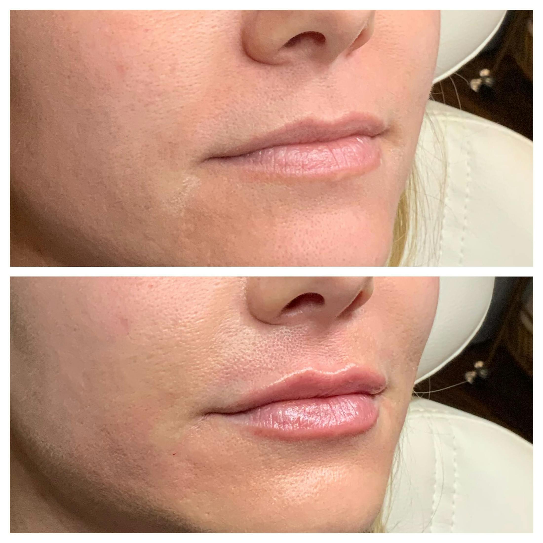 Lips Before & After Gallery - Patient 363148 - Image 2
