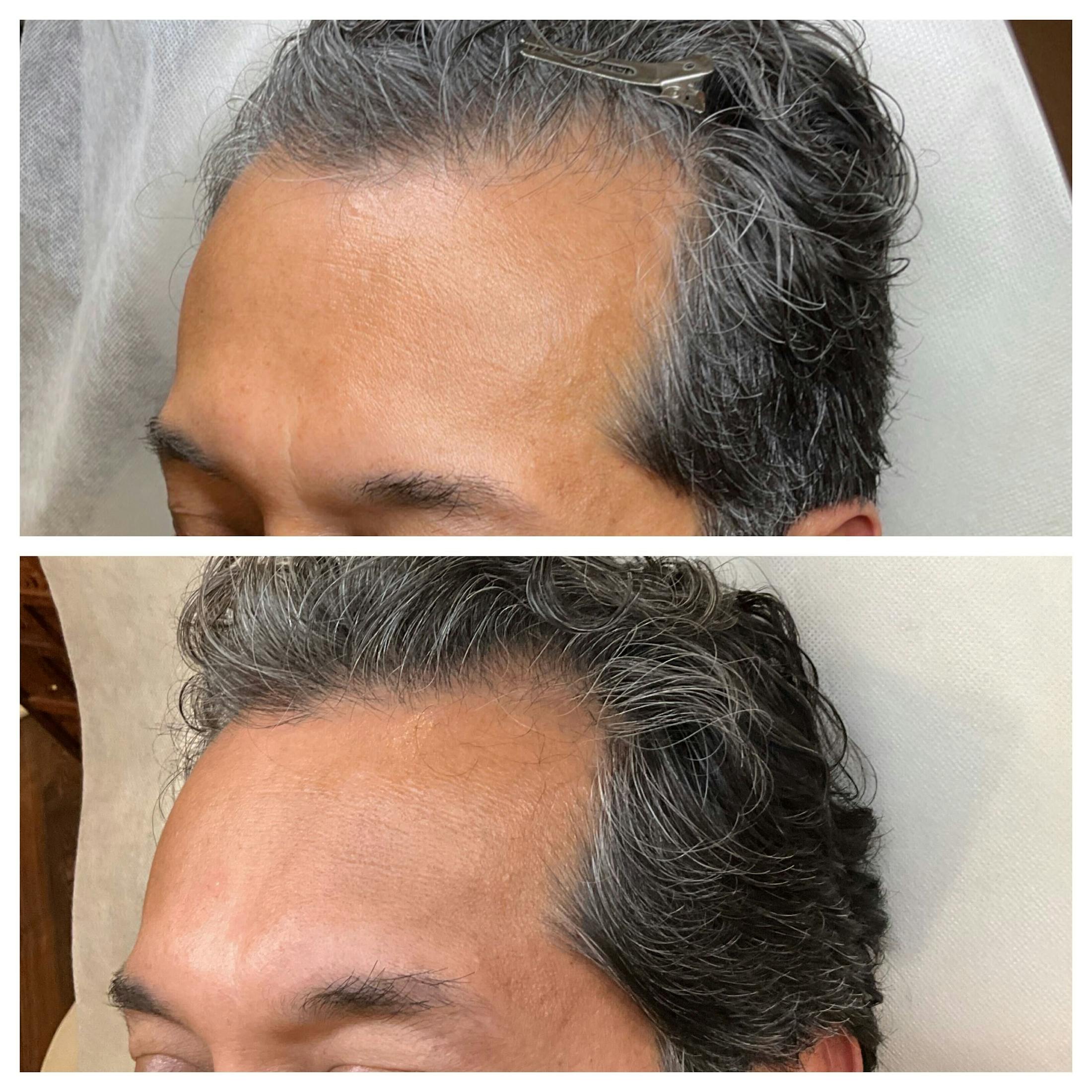 Hair Restoration  Before & After Gallery - Patient 921995 - Image 2