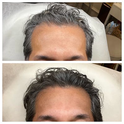 Hair Restoration  Before & After Gallery - Patient 921995 - Image 1
