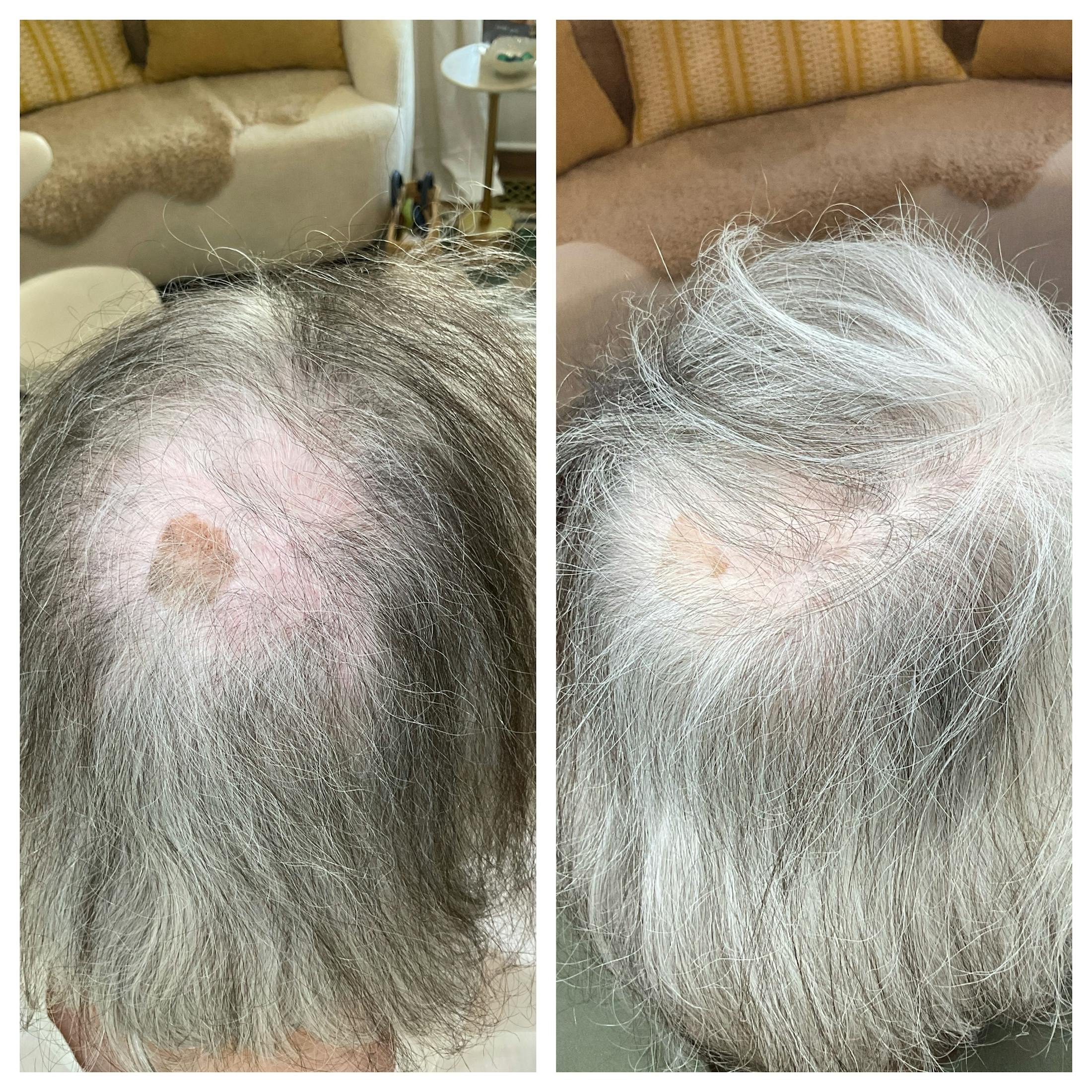 Hair Restoration  Before & After Gallery - Patient 121582 - Image 1