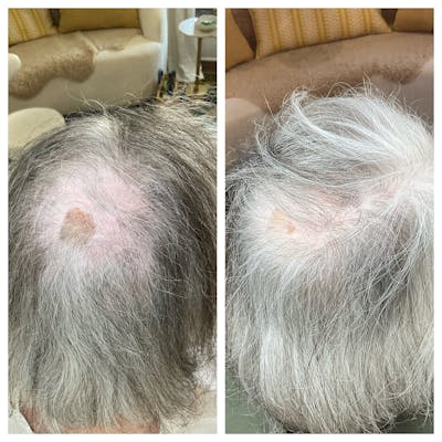 Hair Restoration  Before & After Gallery - Patient 121582 - Image 1