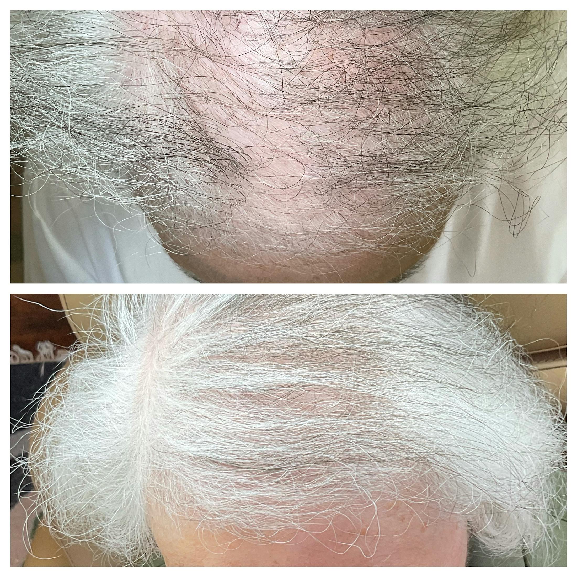 Hair Restoration  Before & After Gallery - Patient 121582 - Image 3