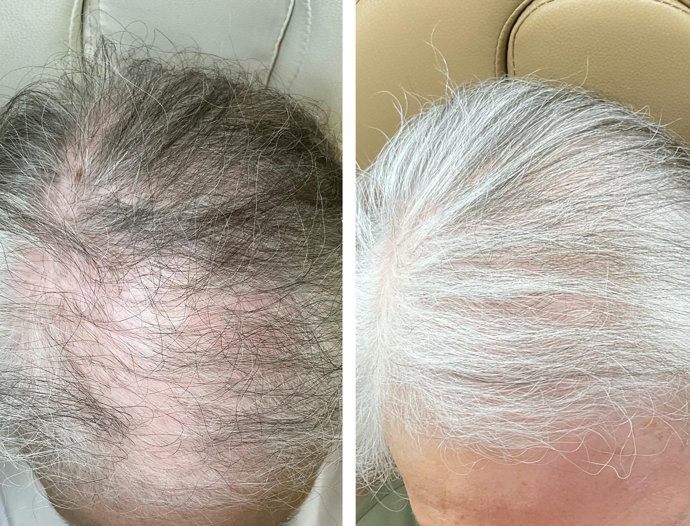 Hair Restoration  Before & After Gallery - Patient 121582 - Image 2