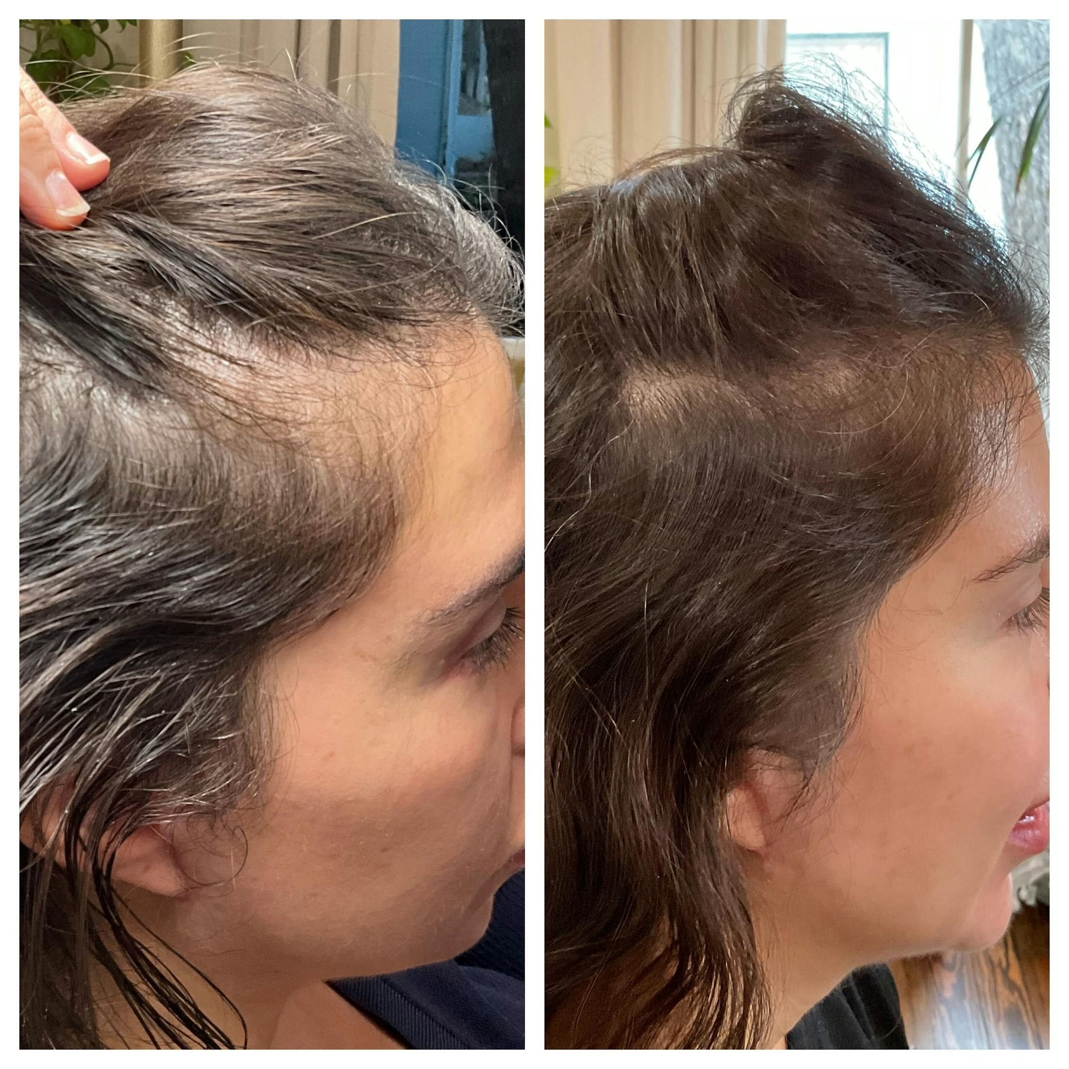 Hair Restoration  Before & After Gallery - Patient 299386 - Image 1
