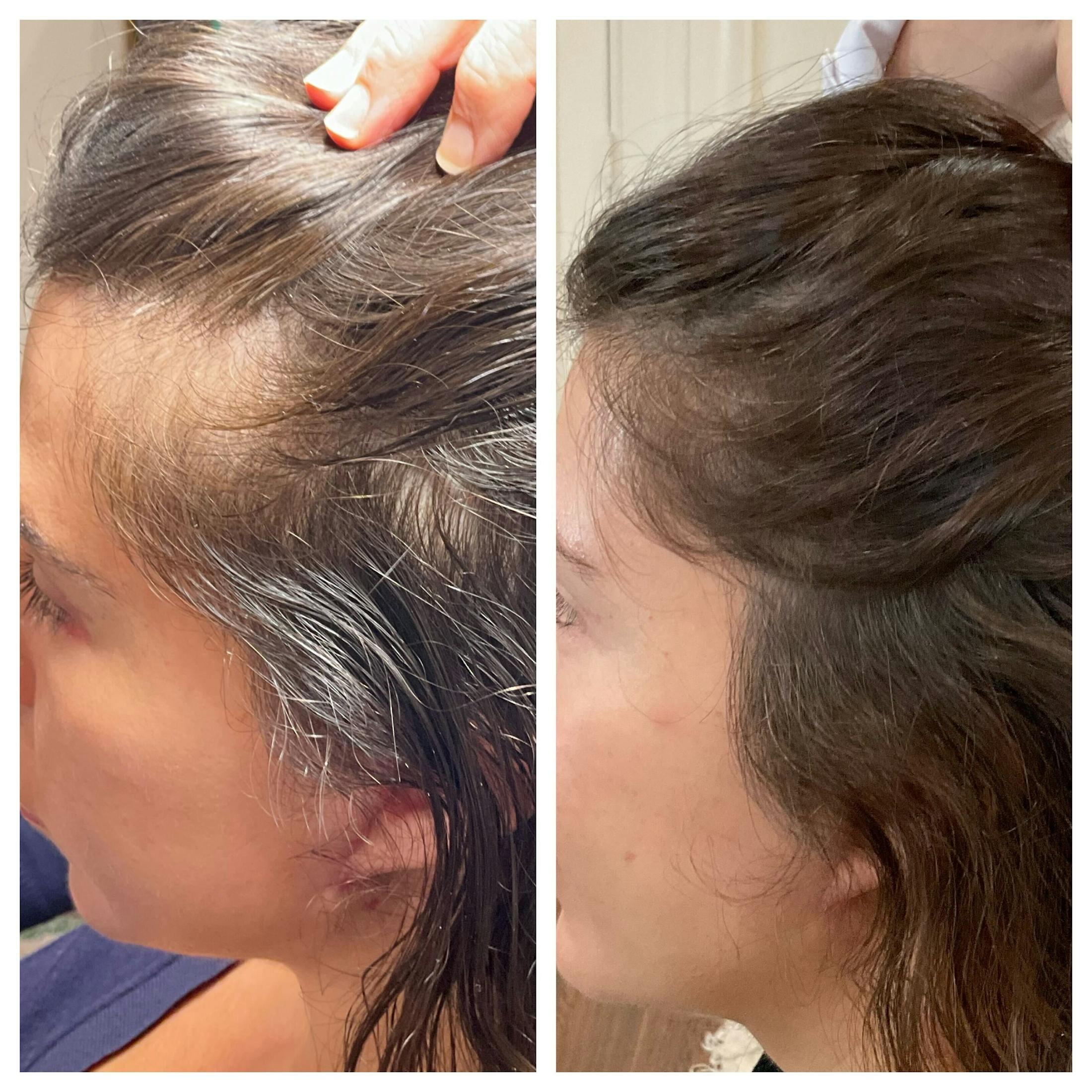 Hair Restoration  Before & After Gallery - Patient 299386 - Image 2
