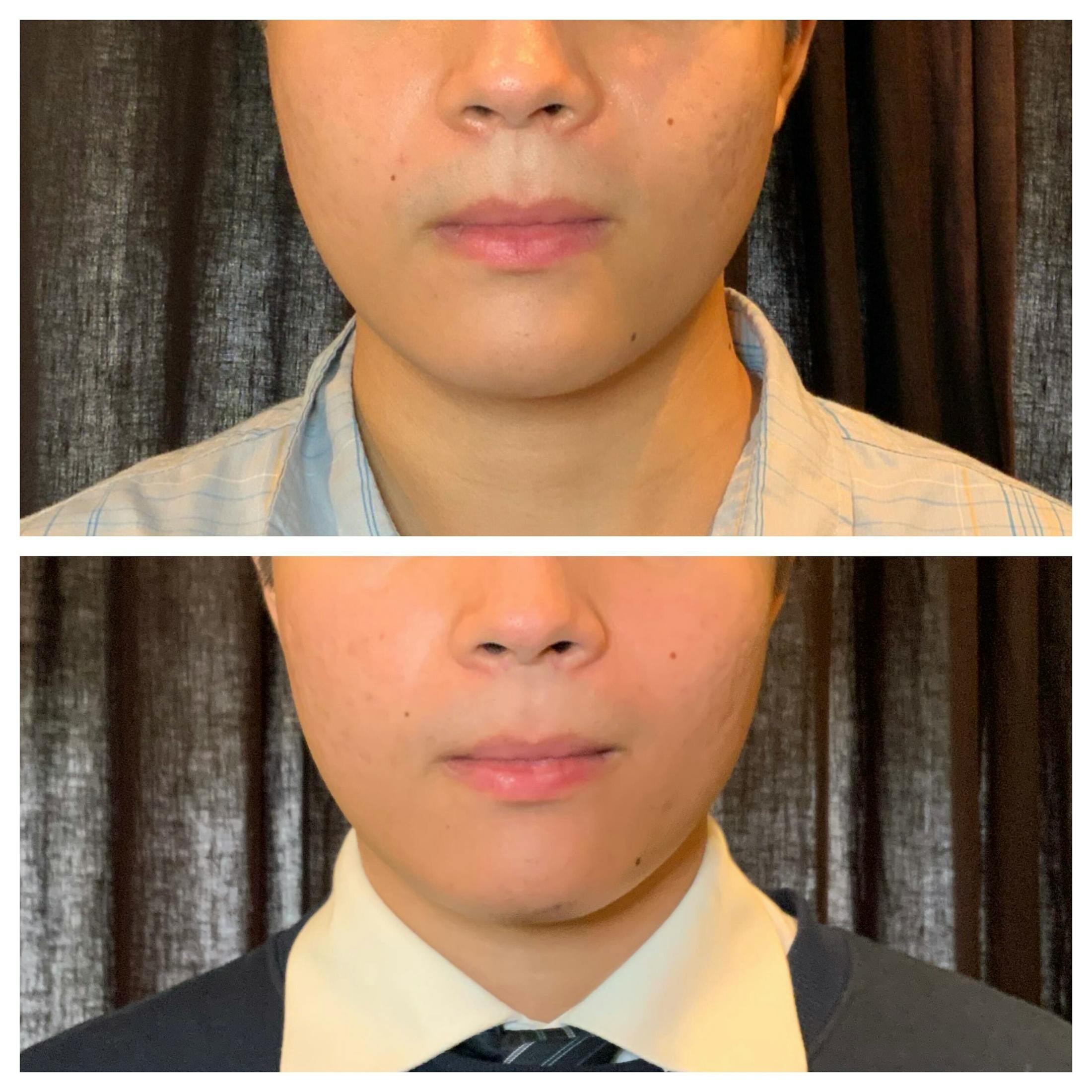 RF Microneedling Before & After Gallery - Patient 244406 - Image 1