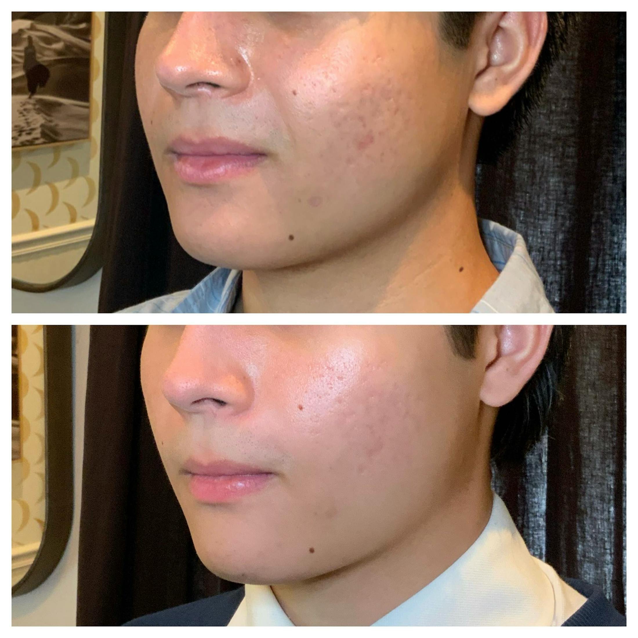 RF Microneedling Before & After Gallery - Patient 244406 - Image 3