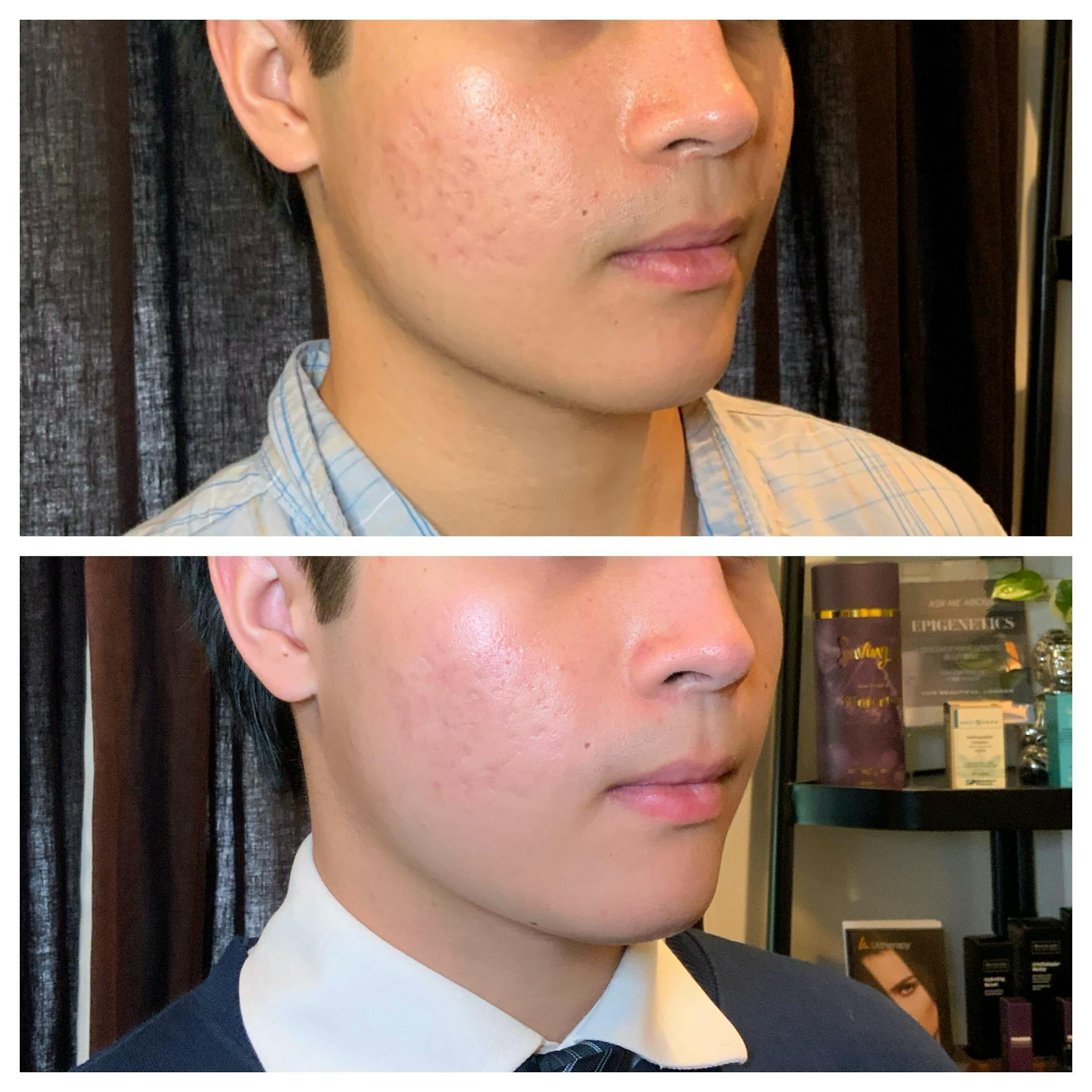 RF Microneedling Before & After Gallery - Patient 244406 - Image 2
