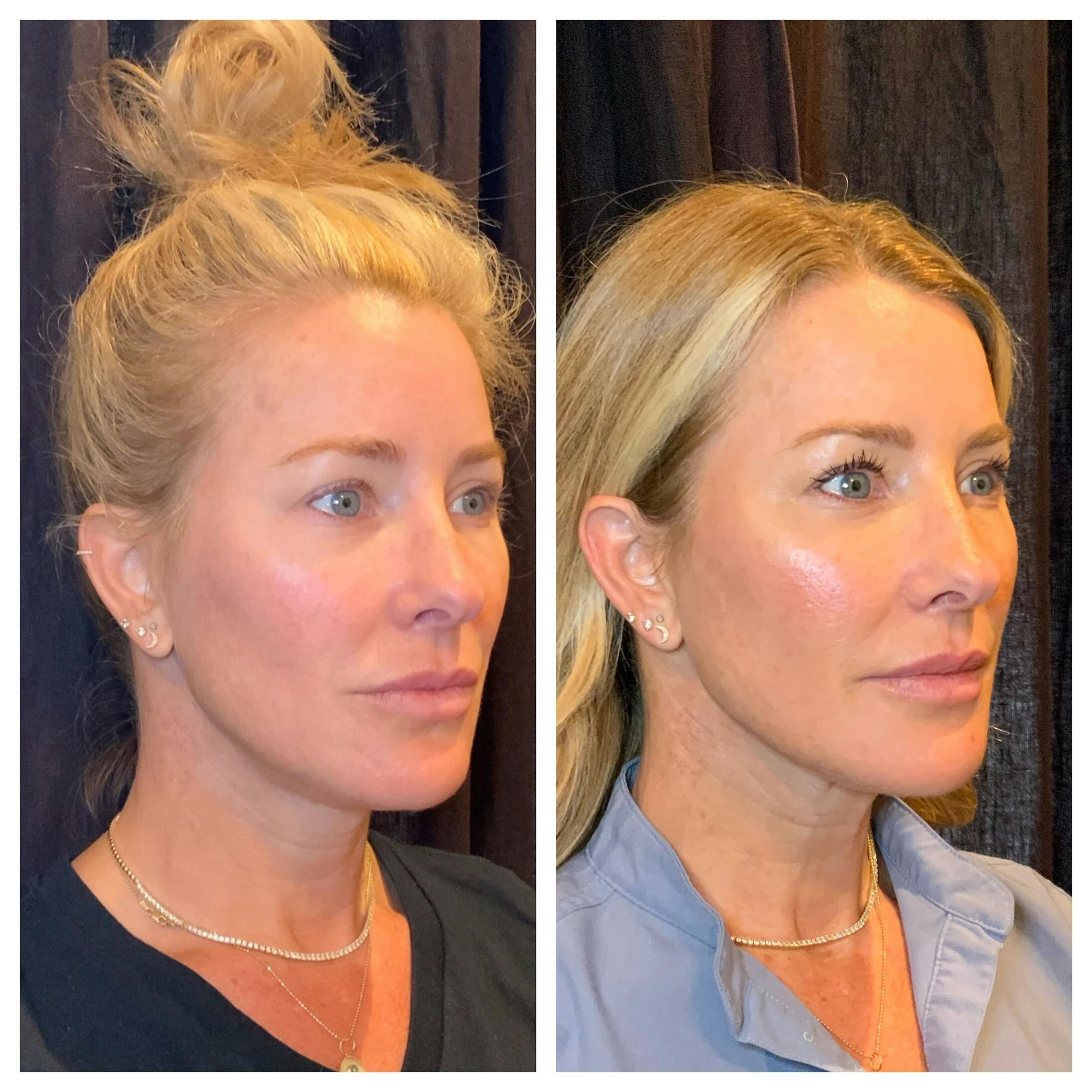 Ultherapy Before & After Gallery - Patient 762426 - Image 1