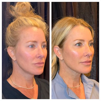 Ultherapy Before & After Gallery - Patient 762426 - Image 1