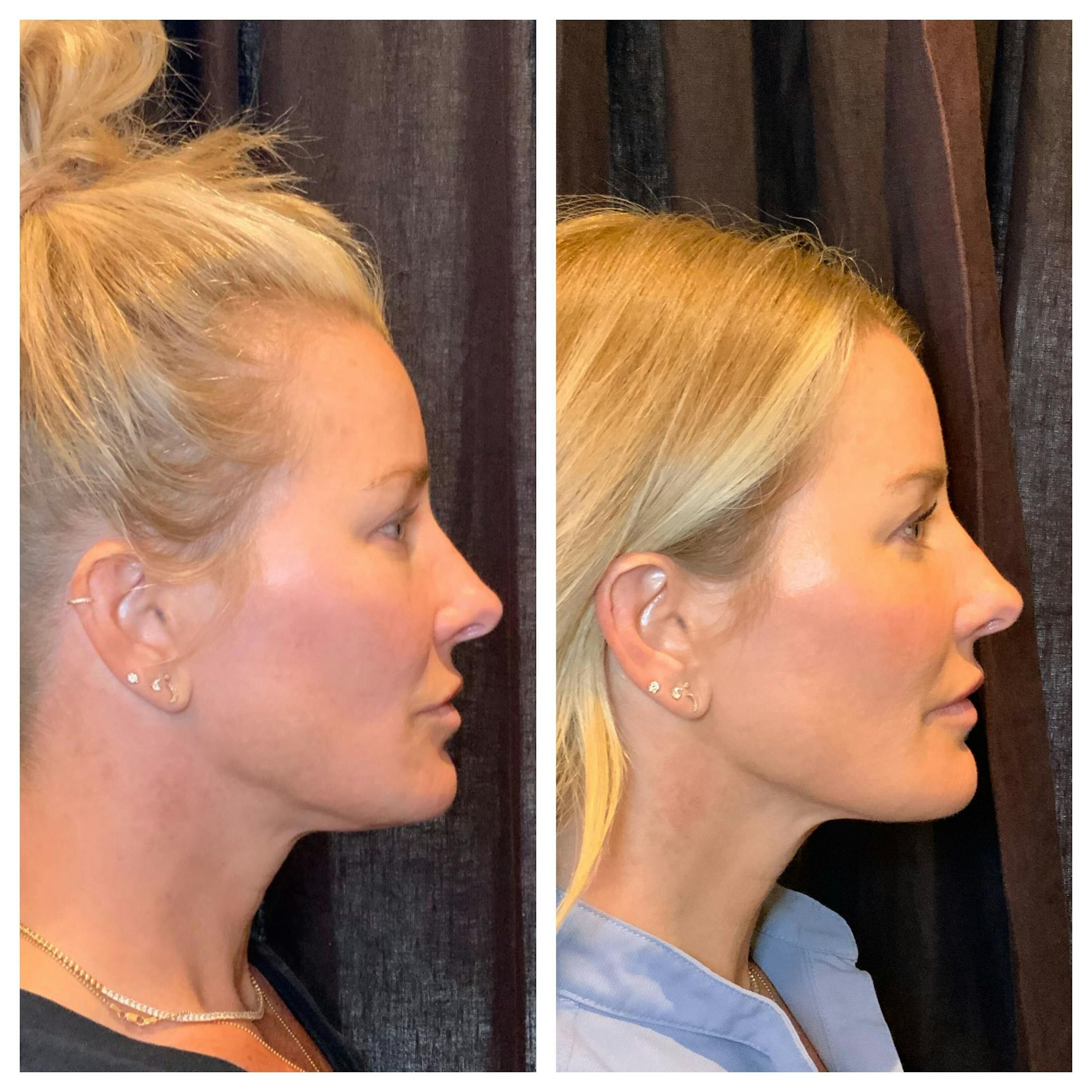 Ultherapy Before & After Gallery - Patient 762426 - Image 2