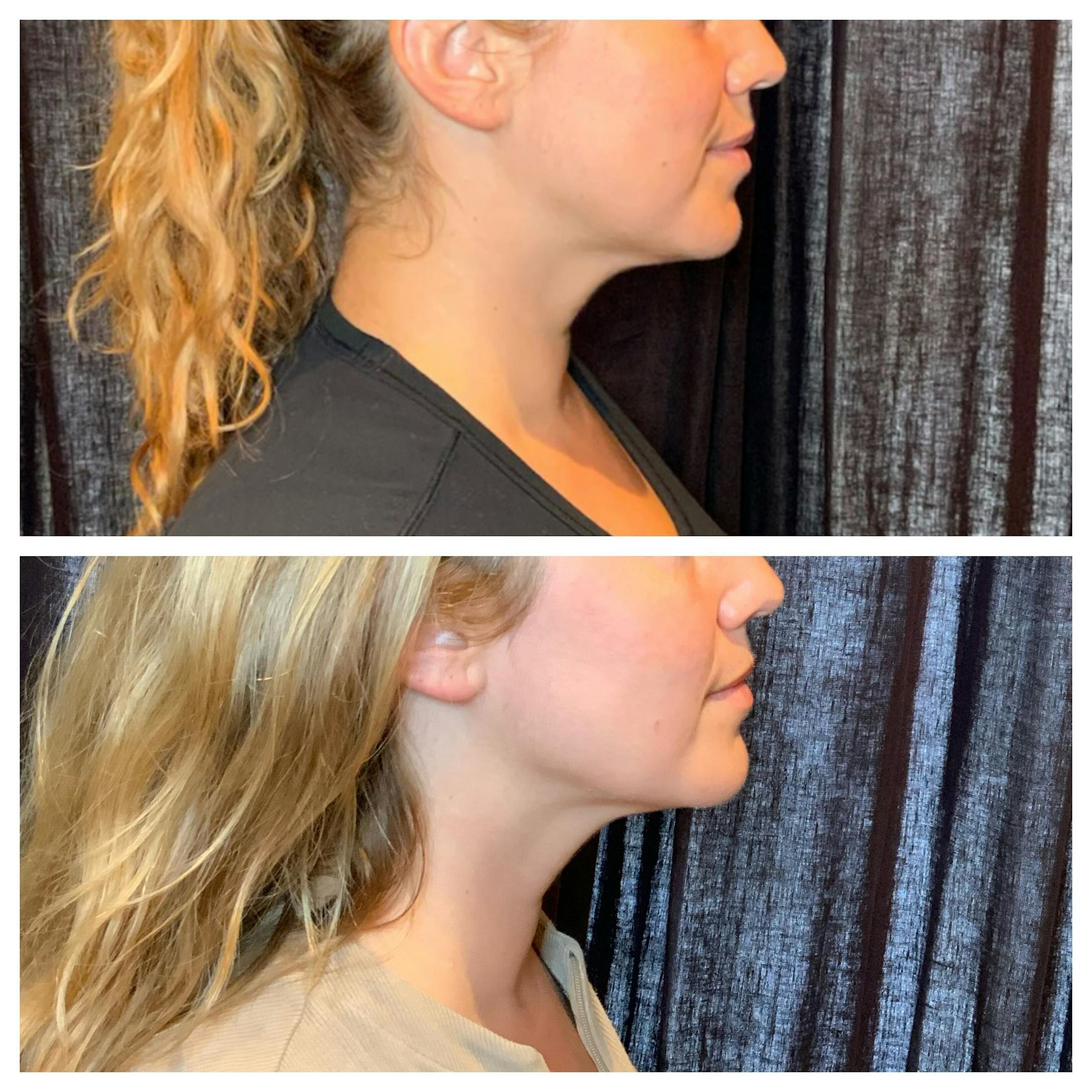 Ultherapy Before & After Gallery - Patient 762426 - Image 5
