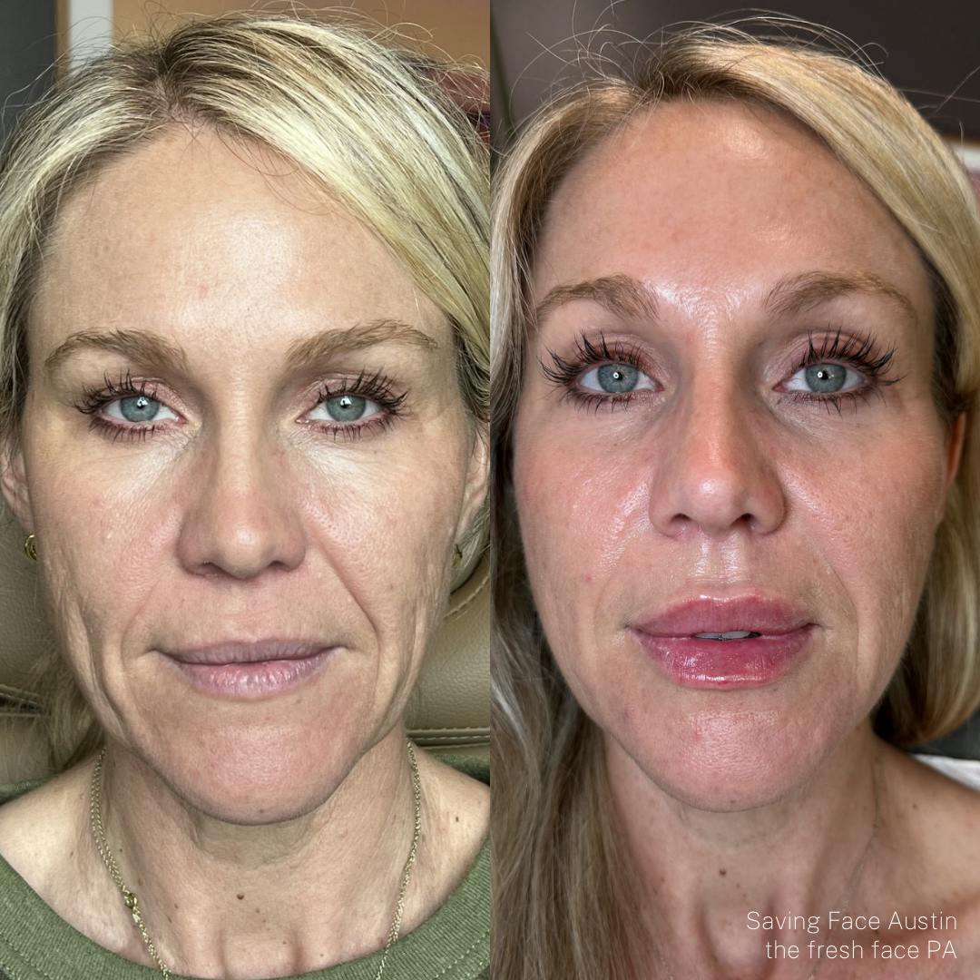 Facial Rejuvenation  Before & After Gallery - Patient 321420 - Image 1