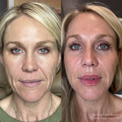 Facial Rejuvenation Before & After Gallery - Patient 321420 - Image 1