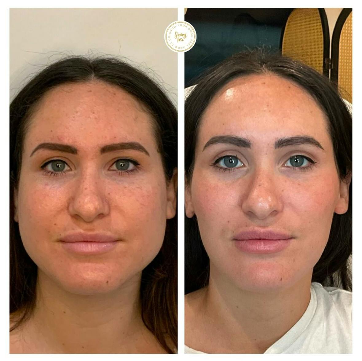 Neuromodulators Before & After Gallery - Patient 400899 - Image 1