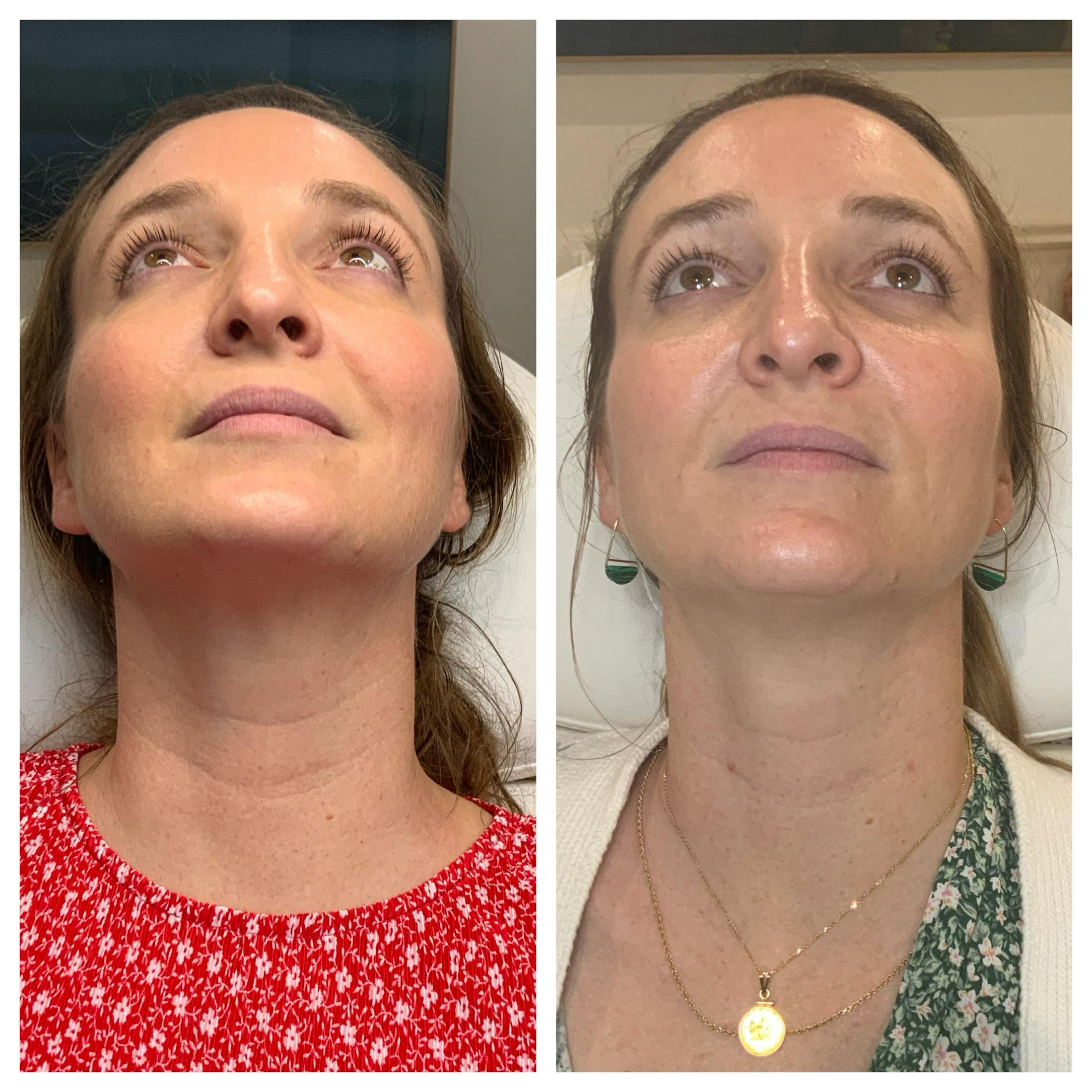 Neuromodulators Before & After Gallery - Patient 282224 - Image 1