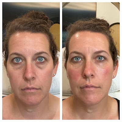 Tear Troughs Before & After Gallery - Patient 387790 - Image 1