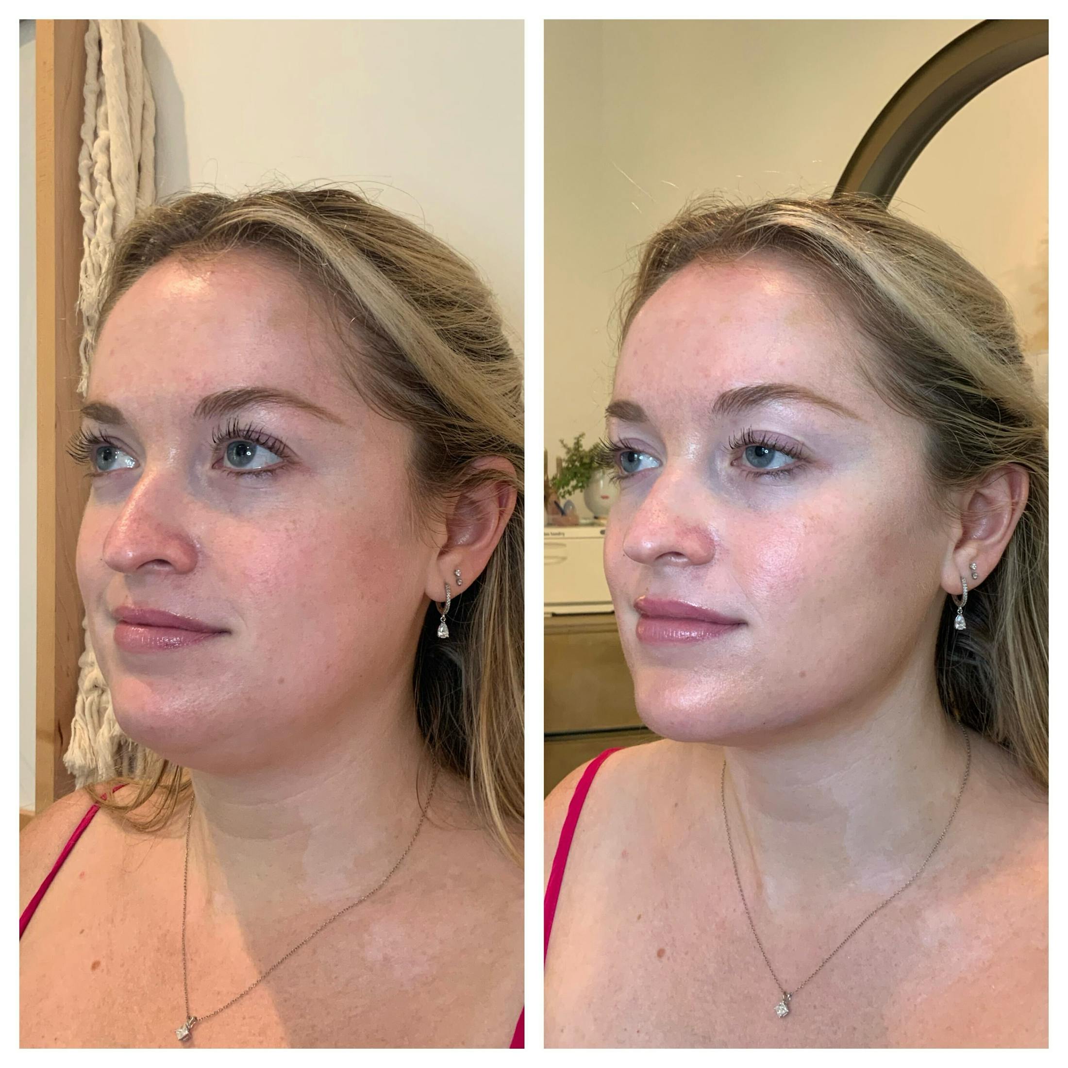 Kybella Before & After Gallery - Patient 371854 - Image 1