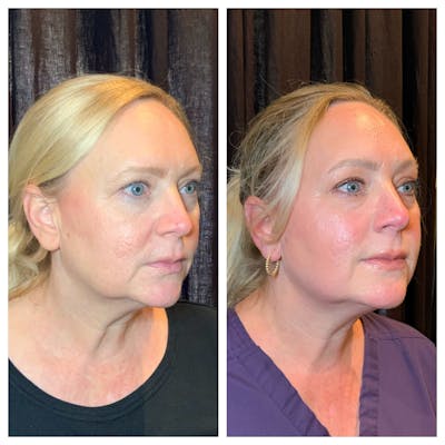 Ultherapy Before & After Gallery - Patient 259956 - Image 1