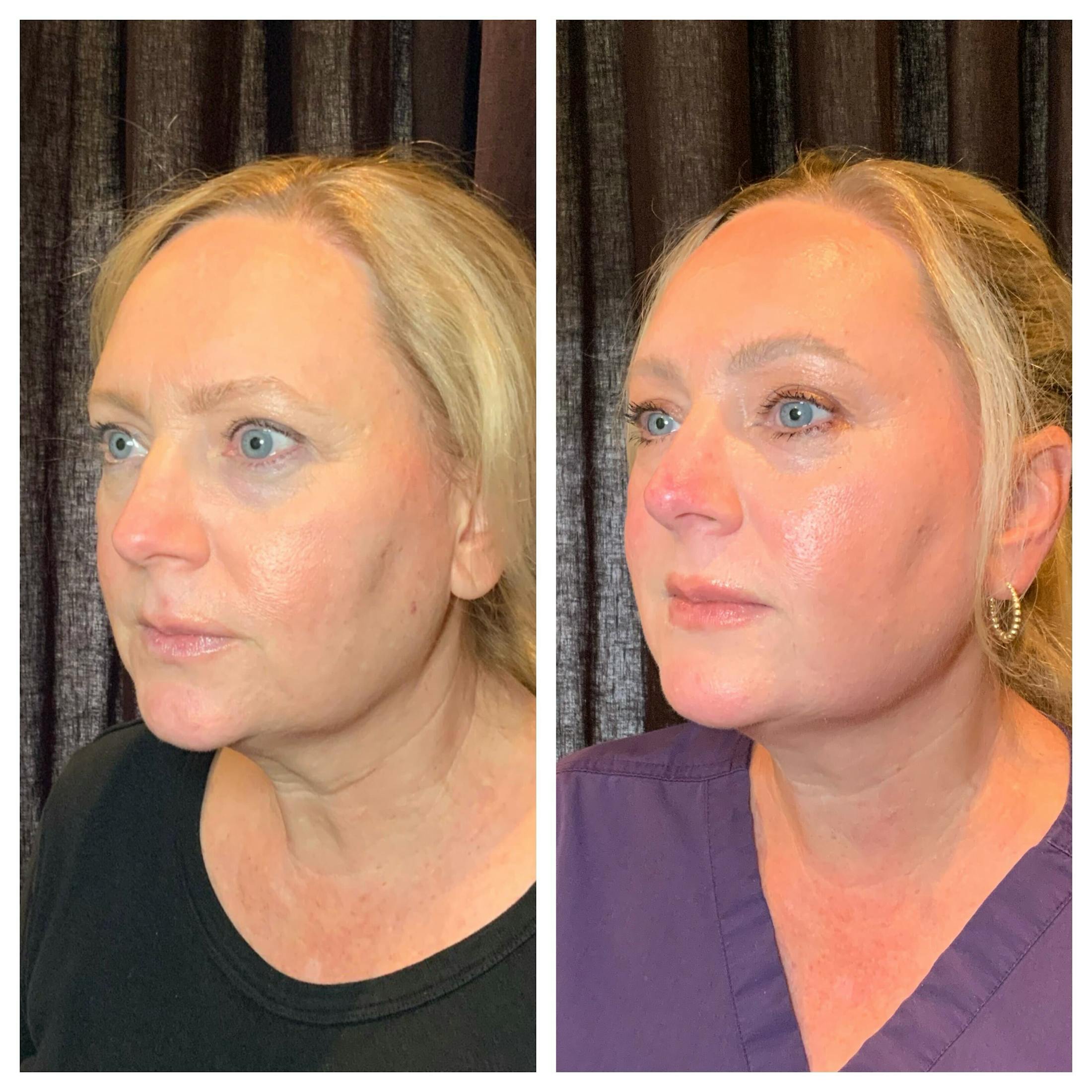 Ultherapy Before & After Gallery - Patient 259956 - Image 2
