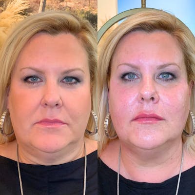 Facial Rejuvenation Before & After Gallery - Patient 383350 - Image 1